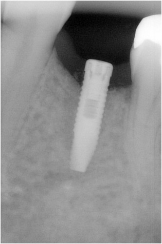 松本8　埋入後約3ヶ月半　ピエゾ骨拡大
